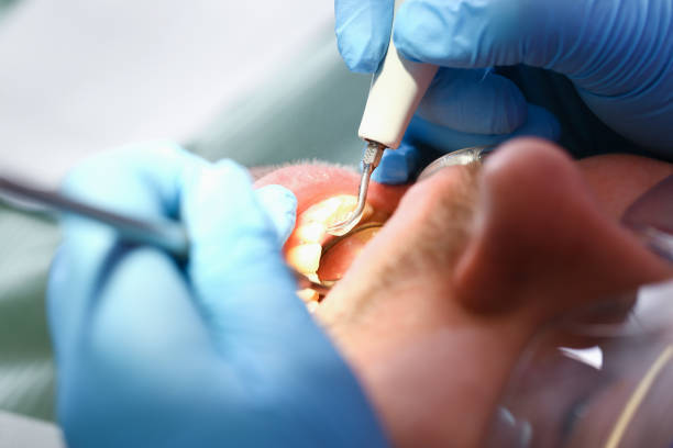 Best Emergency Tooth Extraction in Washburn, ND