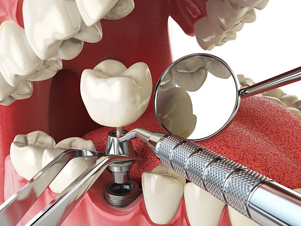 Best Emergency Broken Tooth Repair in Washburn, ND